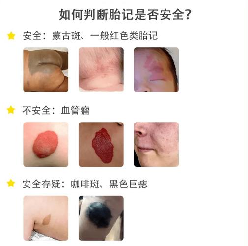 为什么找人代生宝宝会有胎记